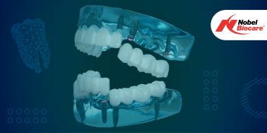 "All on Six" System with Nobel Biocare Implants **